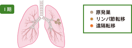 肺がんステージⅠ期