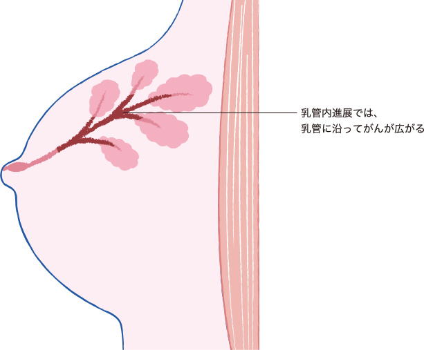 乳管内進展