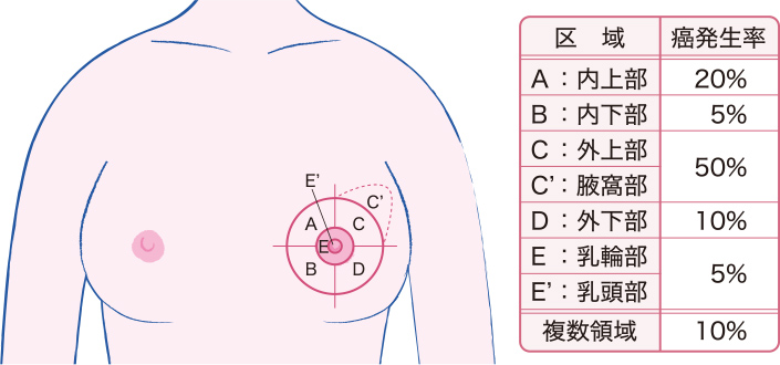 乳がんのできやすい場所