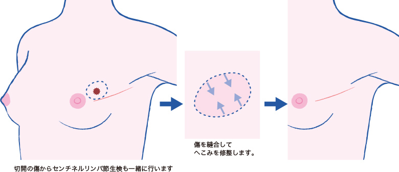 乳房温存術のイメージ図。切開の傷からセンチネルリンパ節生検も一緒に行います。傷を縫合してへこみを修整します。
