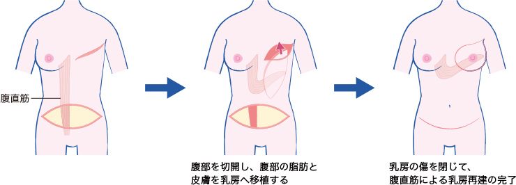 腹直筋皮弁法のイメージ図