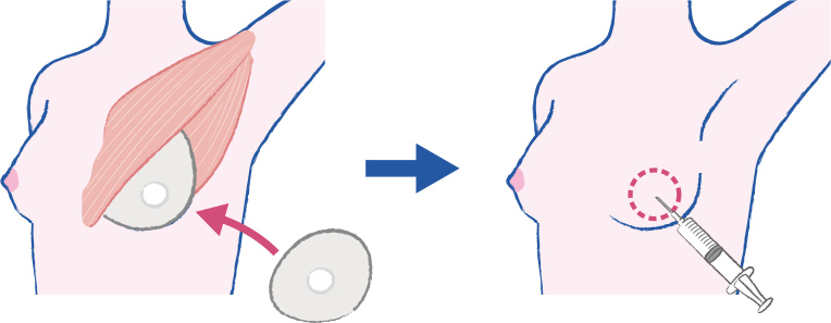 乳房切除後に人工物を挿入する方法のイメージ図