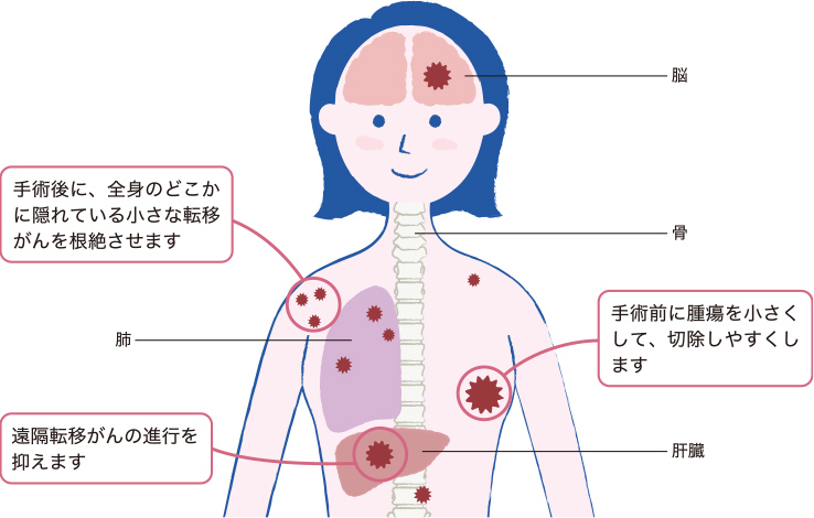 乳がんの再発とは何ですか？
