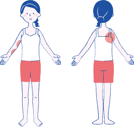 腕から脇の下にかけて、肩甲骨のあたりなど腋窩リンパ節郭清後にむくみやすい箇所をイラストで提示。