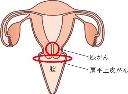 扁平上皮がんと腺がんの位置を示した子宮の構造イラスト