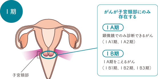 子宮の構造をもとに子宮頸がんステージⅠの間質への浸潤の深さを説明したイラスト