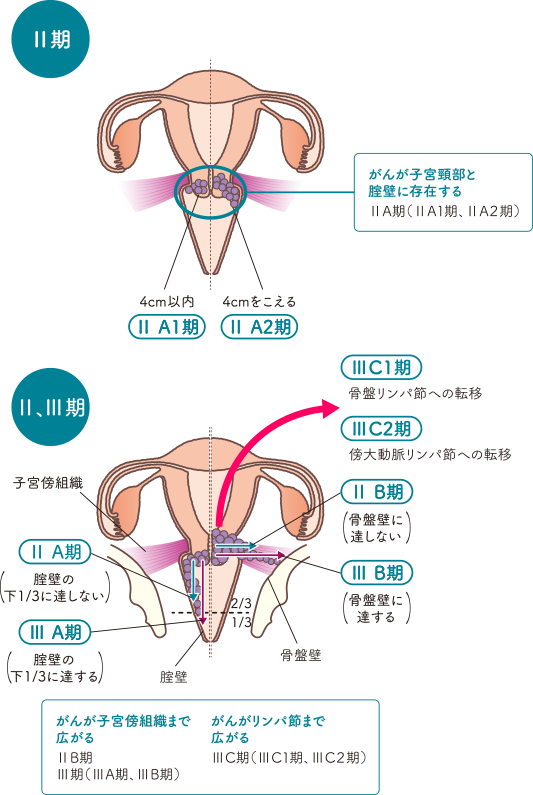 子宮の構造をもとに子宮頸がんステージⅡの状態を説明したイラスト