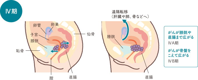 子宮頸がんステージⅣの状態を説明したイラスト
