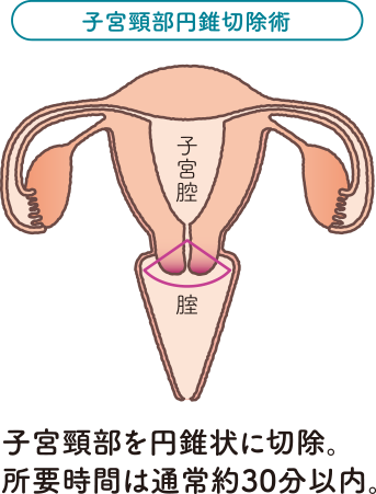 子宮の構造をもとに子宮頸部円錐切除術を説明したイラスト。子宮頸部を円錐状に切除。所要時間は通常約30分以内。