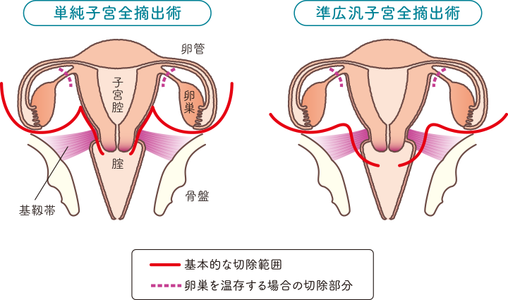 子宮の構造をもとに単純子宮全摘出術と準広汎子宮全摘出術の基本的な切除範囲と卵巣を温存する場合の切除部分を説明したイラスト