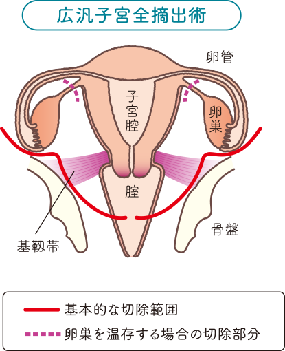 子宮の構造をもとに広汎子宮全摘出術の基本的な切除範囲と卵巣を温存する場合の切除部分を説明したイラスト