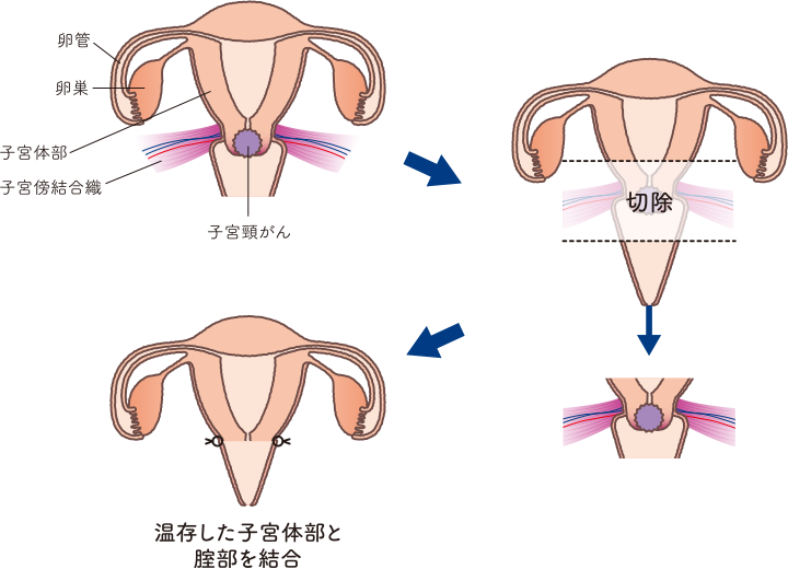 子宮の構造をもとに広汎子宮頸部摘出術を説明したイラスト