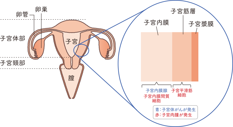 子宮肉腫 おしえて 子宮 卵巣のコト 中外製薬