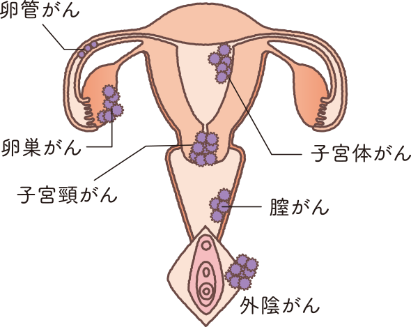 外陰がん おしえて 子宮 卵巣のコト 中外製薬