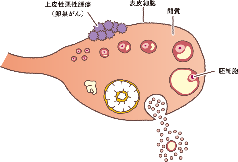 卵巣における上皮性悪性腫瘍（卵巣がん）の発症イメージをイラストで解説