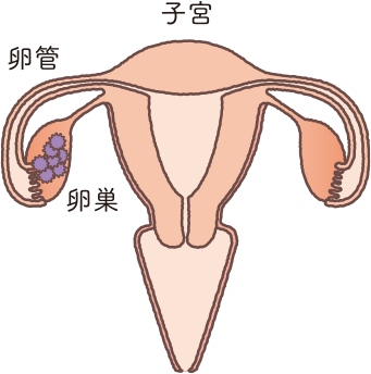 子宮の構造をもとに卵巣がんステージⅠの状態を説明したイラスト