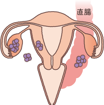 子宮の構造をもとに卵巣がんステージⅡの状態を説明したイラスト