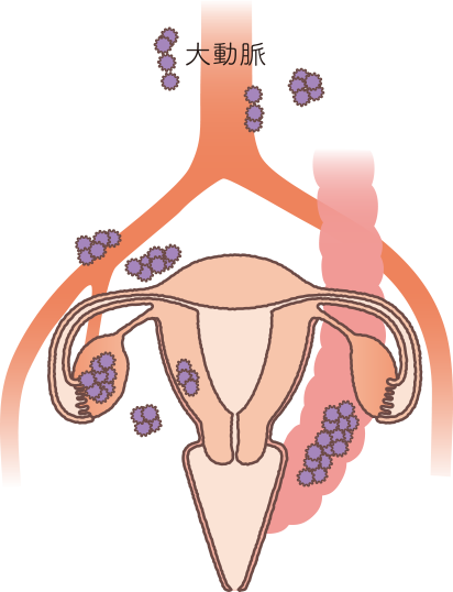 子宮の構造をもとに卵巣がんステージⅢの状態を説明したイラスト