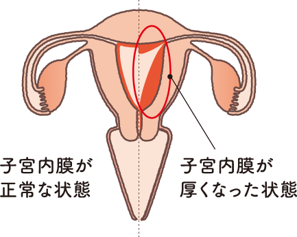 子宮内膜が正常な状態と、子宮内膜が厚くなった状態