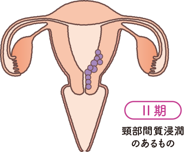 子宮の構造をもとに子宮体がんステージⅡの状態を説明したイラスト