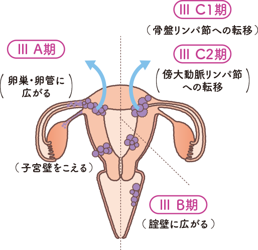 子宮の構造をもとに子宮体がんステージⅢの状態を説明したイラスト
