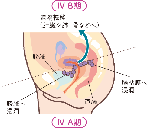 子宮の構造をもとに子宮体がんステージⅣB期の状態を説明したイラスト