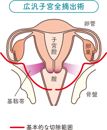 子宮の構造をもとに広汎子宮全摘出術の基本的な切除範囲と卵巣を温存する場合の切除部分を説明したイラスト