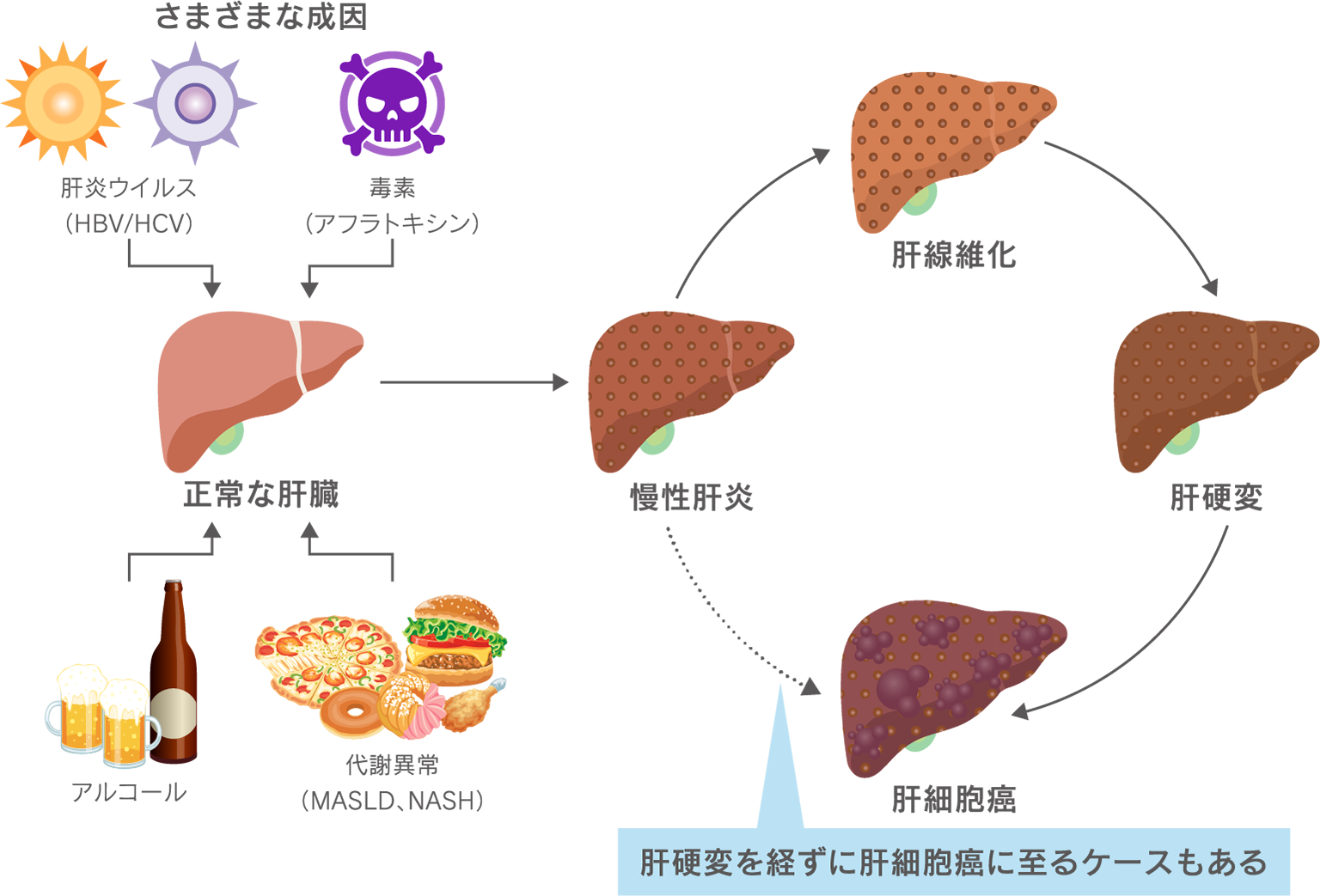 肝炎ウイルスや毒素、アルコールや代謝異常によって慢性肝炎となり、肝がんにいたる様子