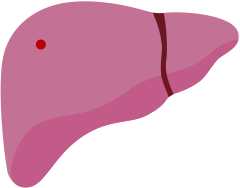 肝がんの病期分類T1の肝臓イメージ
