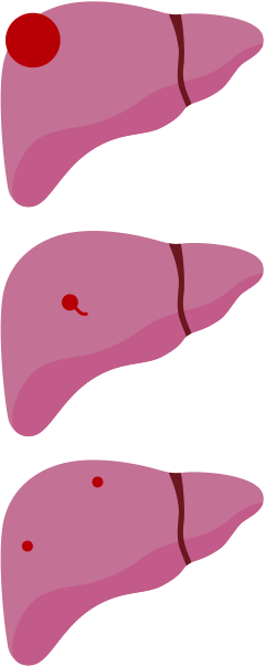 肝がんの病期分類T2の肝臓イメージ