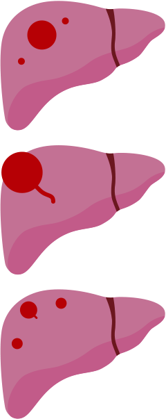 肝がんの病期分類T3の肝臓イメージ