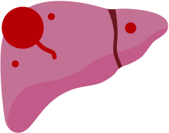 肝がんの病期分類T4の肝臓イメージ