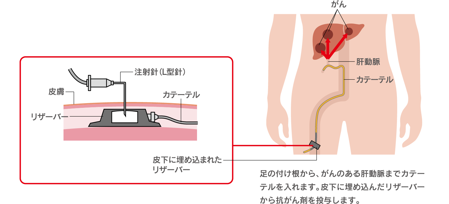 肝動注化学療法をイラストで表現。足の付け根から、がんのある肝動脈までカテーテルを入れ、皮下に埋め込んだリザーバーから抗がん剤を投与する。