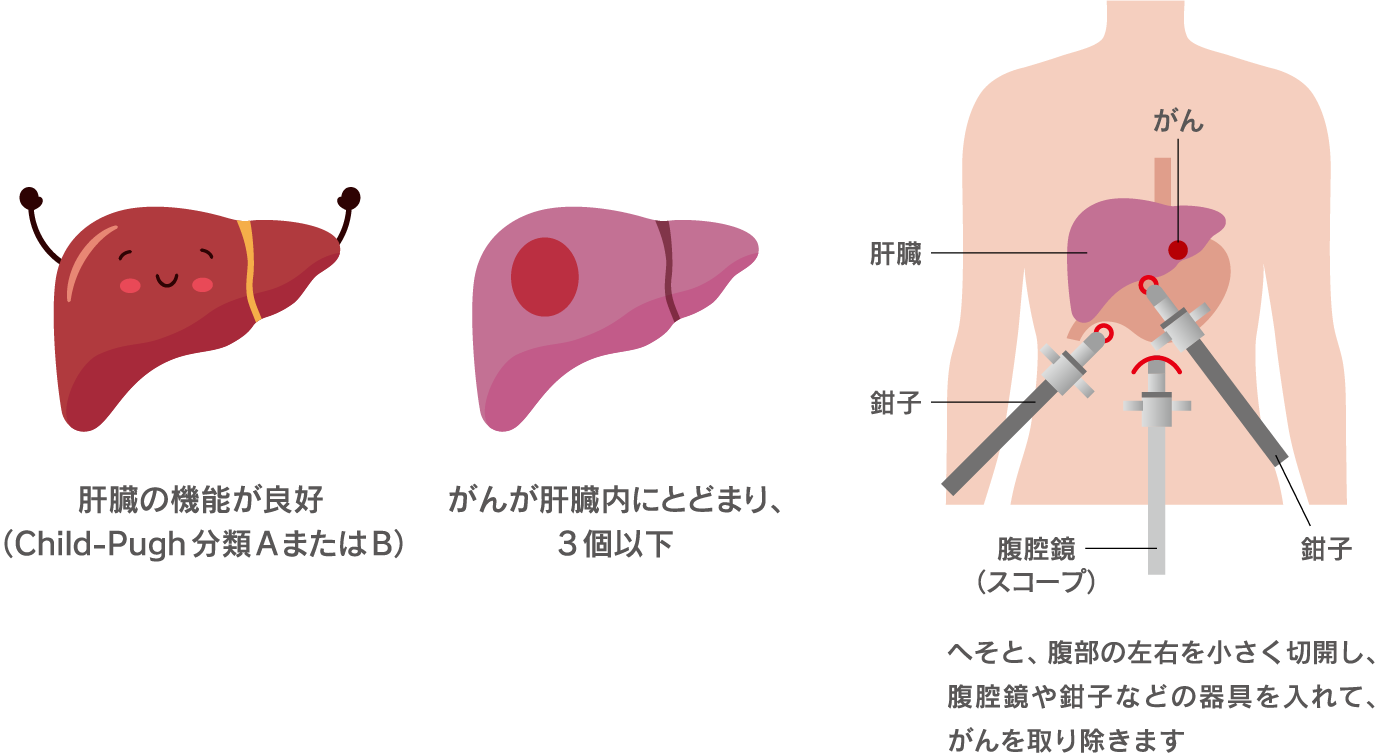 肝切除の方法をイラストで表現。へそと腹部の左右を小さく切開し、腹腔鏡や鉗子などの器具を入れて、がんを取り除く