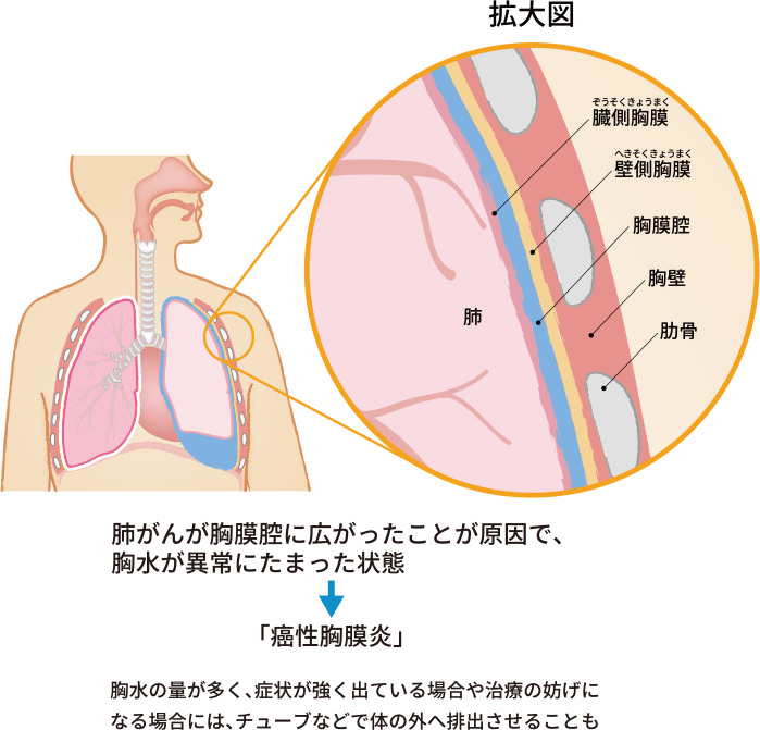 肺の一部を拡大したイメージ図で胸水を説明