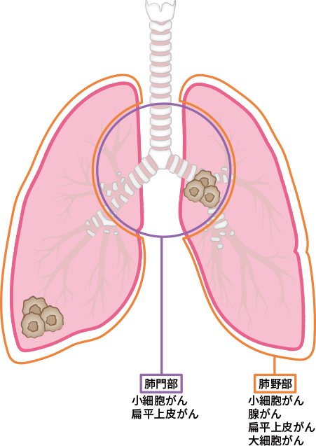 肺がんの発生部位でみると、肺門部では小細胞がんと扁平上皮がんが多く発生し、肺野部では小細胞がん、腺がん、扁平上皮がん、大細胞がんが多く発生します。