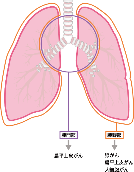 腺がん、大細胞がんは肺野部に、扁平上皮がんは肺野部および肺門部に発生することを図解
