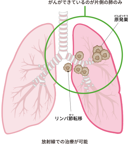 がんができているのが片側の肺にとどまっている場合、放射線での治療が可能