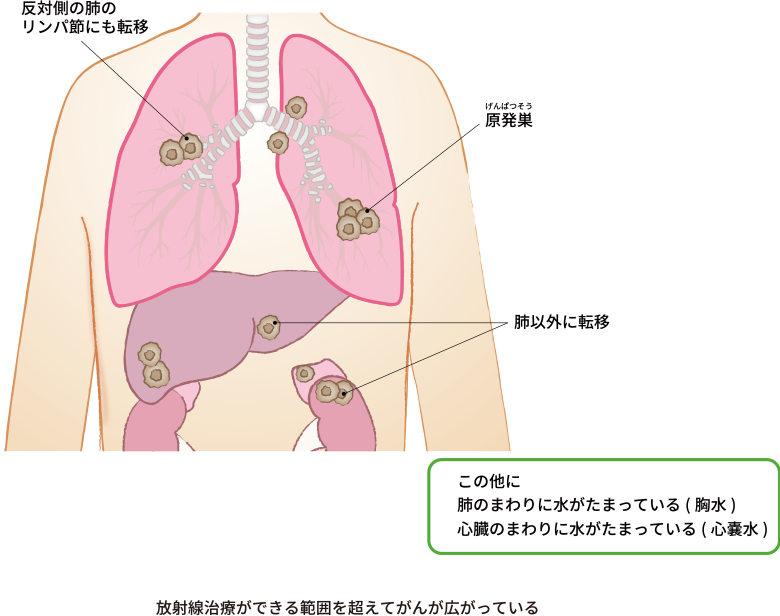 がんが原発巣とは反対側の肺のリンパ節や、肺以外の臓器に転移していたり、胸のまわりに水がたまっている胸水や、心臓のまわりに水がたまる心嚢水のような症状がみられる場合も、放射線で治療ができる範囲を超えて癌が広がっている進展型小細胞肺がんの状態です。