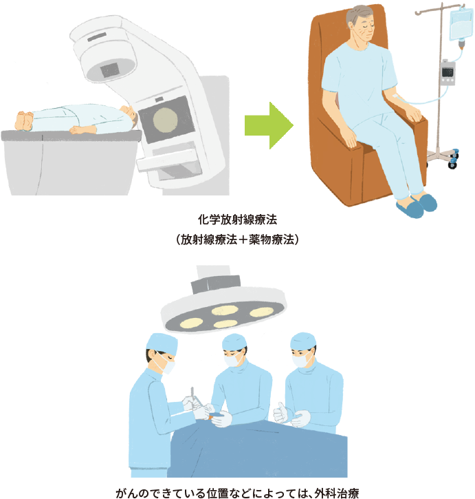 ステージⅢの非小細胞肺がんの化学放射線療法（放射線療法+薬物療法）、がんのできている位置などによっては行われる外科治療のイメージイラスト