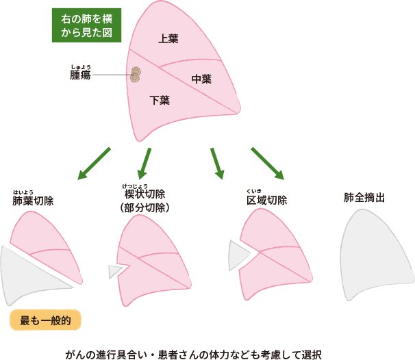 右肺を横から見た図を提示し、肺葉切除、楔状切除（部分切除）、区域切除、肺全摘出を図解