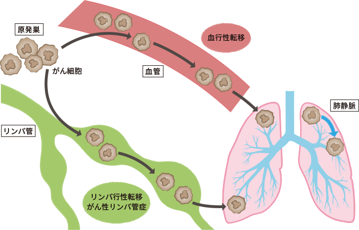 原発巣のがん細胞が血液やリンパの流れに乗って、肺に転移するイメージイラスト