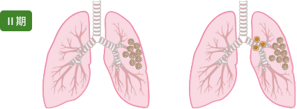 肺がんステージⅡ期