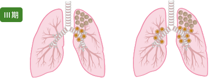肺がんステージⅢ期