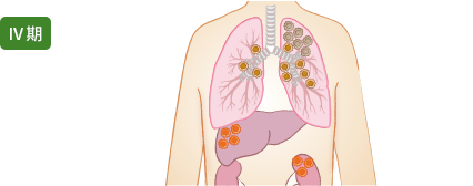 肺がんステージⅣ期