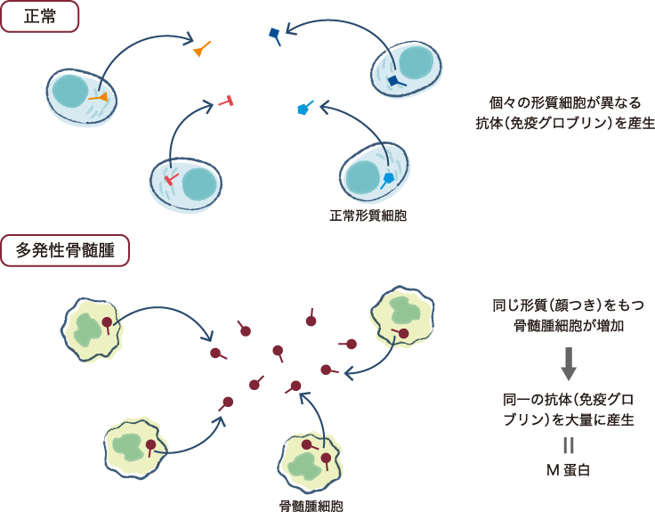 骨髄腫細胞からのMタンパク産生のイメージ図。上述の正常の場合と多発性骨髄腫の場合の違いを図式化